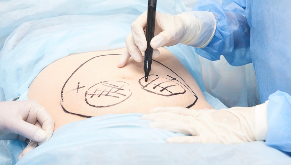 Vaginal Hysterectomy 
